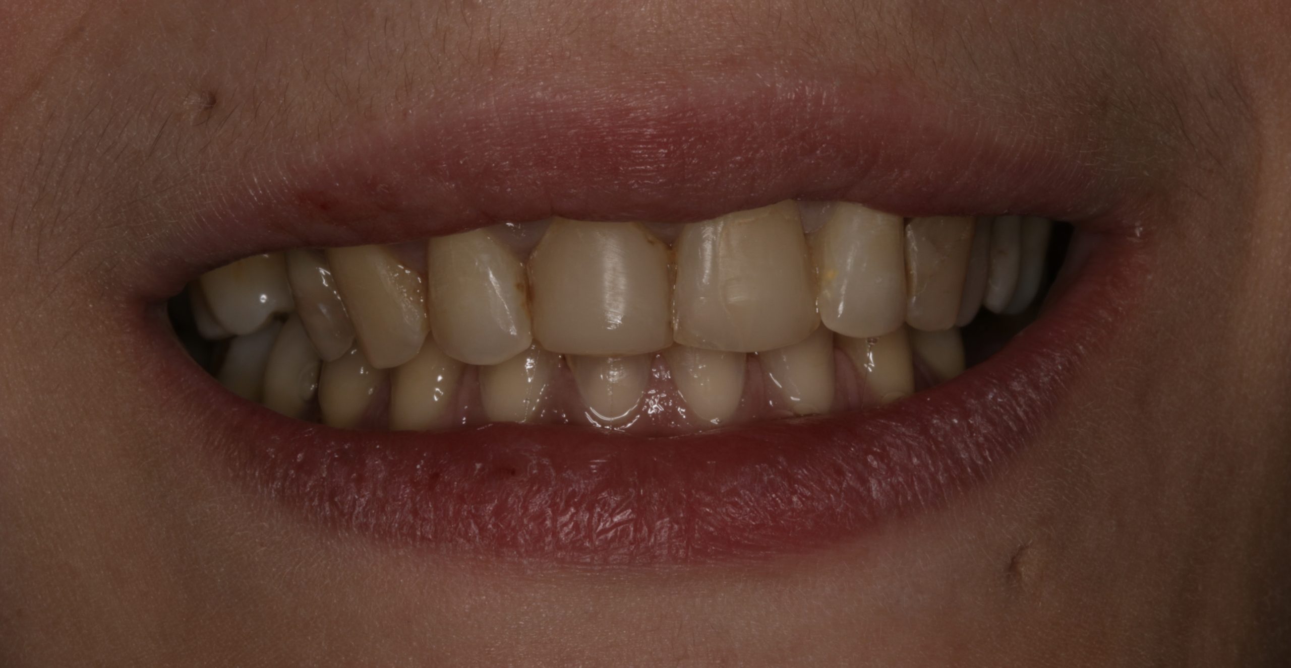 Before cosmetic dentistry treatment