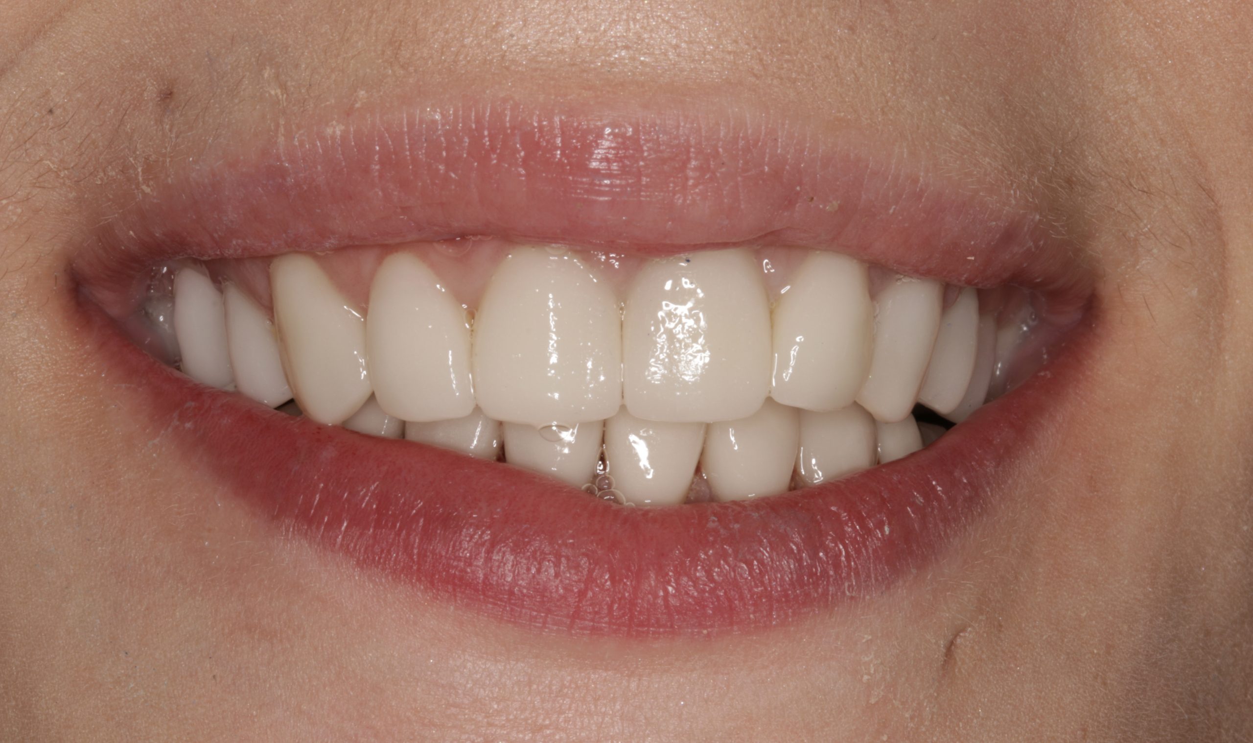 After cosmetic dentistry treatment