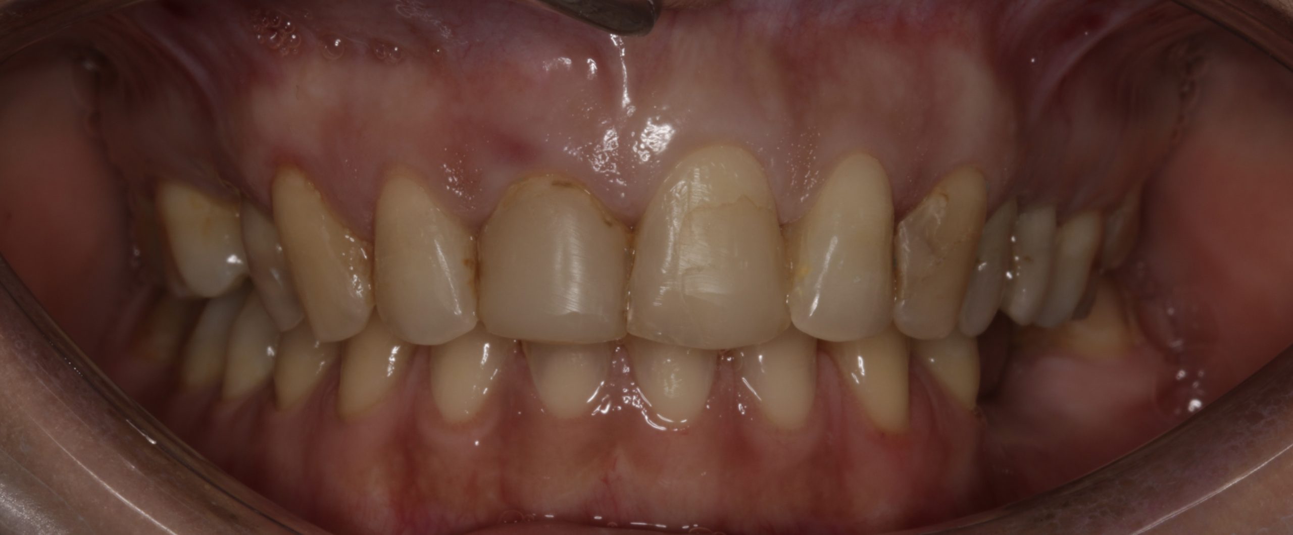 Before porcelain veneers treatment at Staveley Dental Care