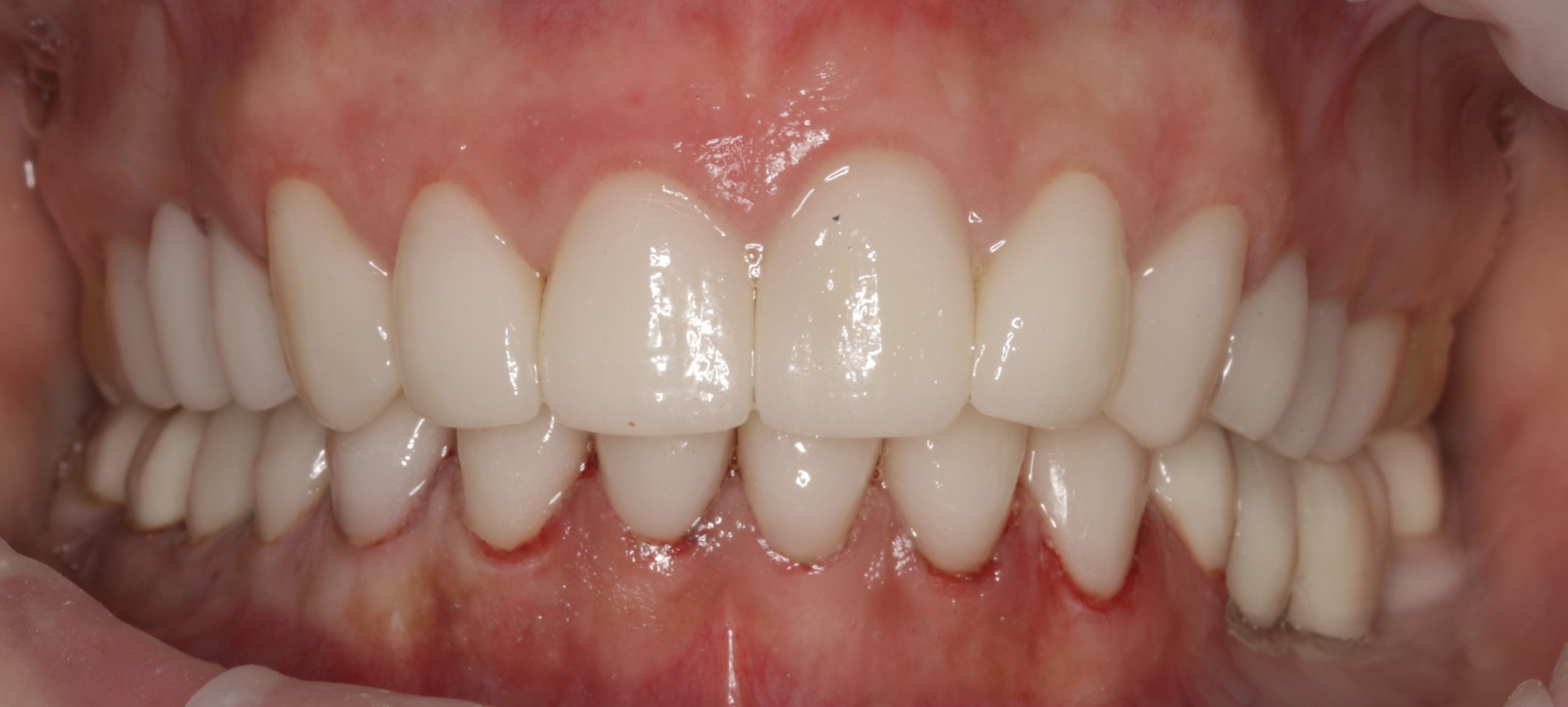 After porcelain veneers treatment at Staveley Dental Care