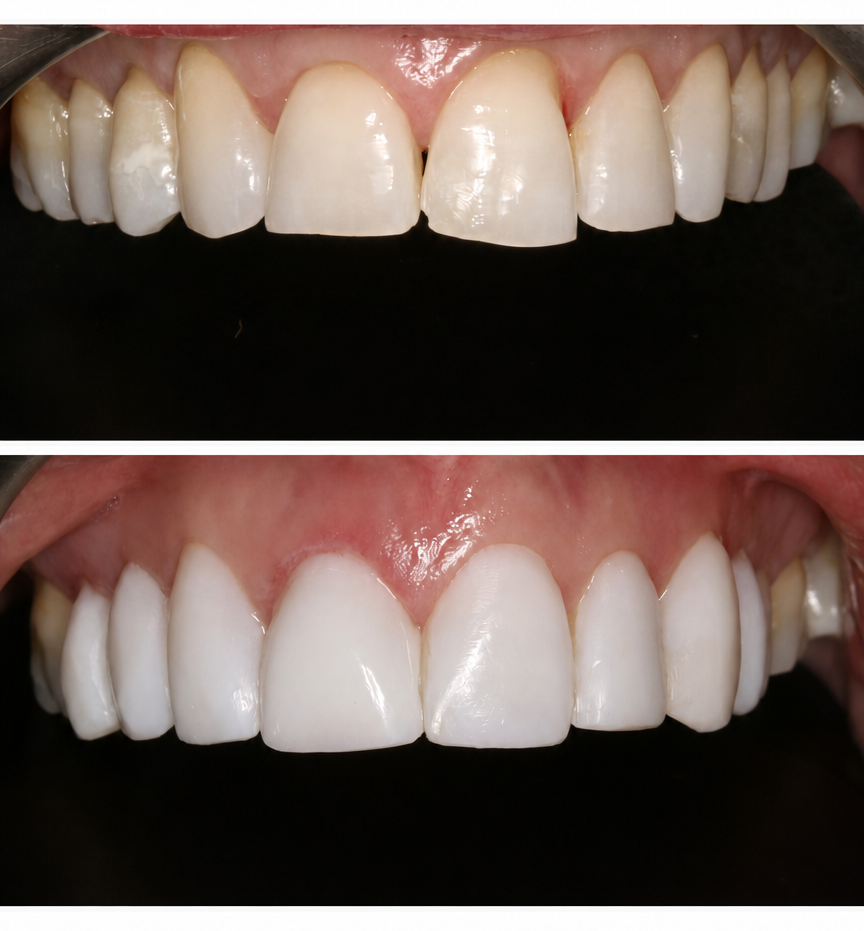 Composite bonding gap closure before and after result at Staveley Dental Care