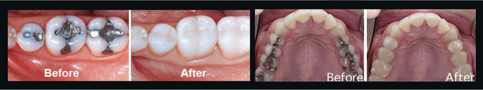 Before and after replacement of old amalgam fillings with white composite fillings at Staveley Dental Care