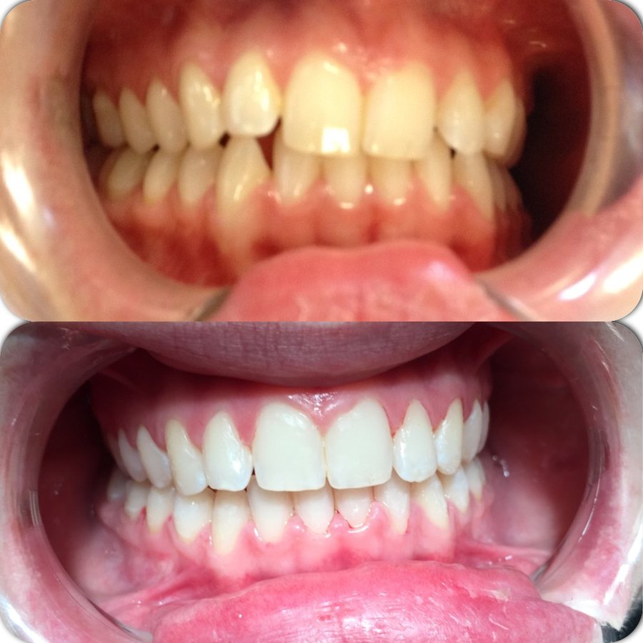 Before and after tooth straightening example 1 from sister practice High Street Dental Care