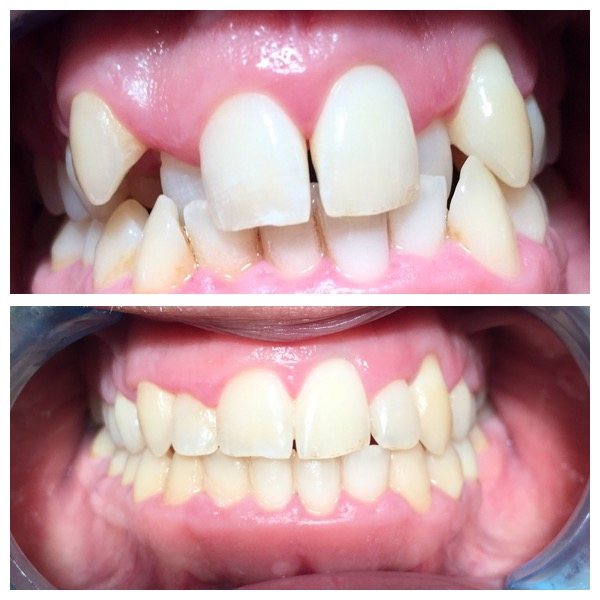 Before and after tooth straightening example 2 from sister practice High Street Dental Care