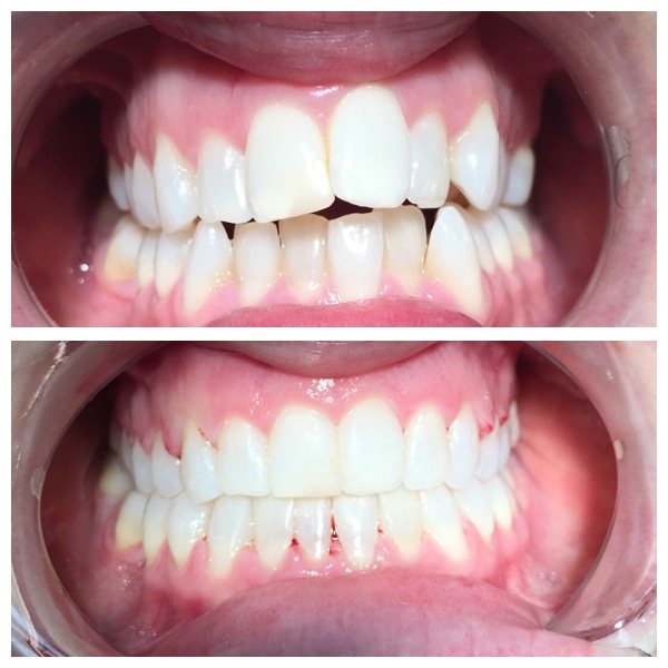 Before and after tooth straightening example 3 from sister practice High Street Dental Care